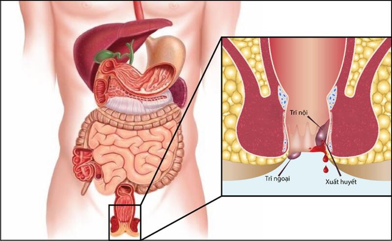 Người bị bệnh trĩ có thể bị chảy máu trực tràng