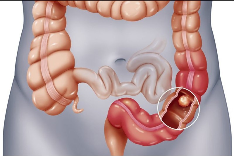 Khi vi khuẩn xâm nhập vào đại tràng sẽ gây ra tình trạng viêm đại tràng