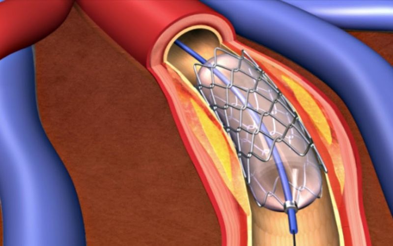 Chi phí đặt stent đặt stent mạch vành rơi vào khoảng 40 đến 50 triệu đồng cho một stent.