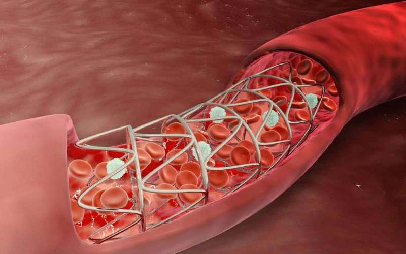 Stent mạch vành ra đời với vai trò giải quyết tắc nghẽn, lưu thông mạch máu