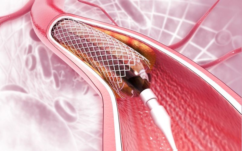 Đặt stent mạch vành cấp cứu được chỉ định trong trường hợp nhồi máu cơ tim cấp tính.