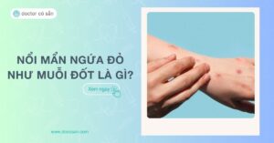 Nổi mẩn đỏ ngứa như muỗi đốt là gì? Nguyên nhân, cách điều trị