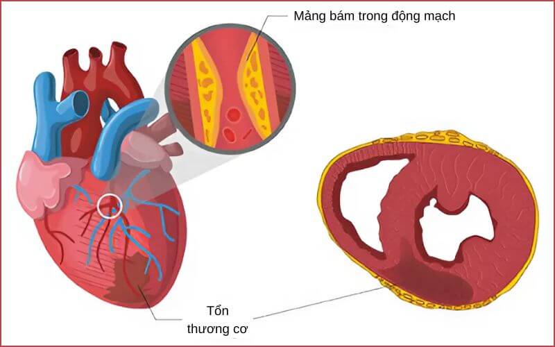 Mảng bám tích tụ làm hẹp lòng động mạch và gây xơ vữa động mạch