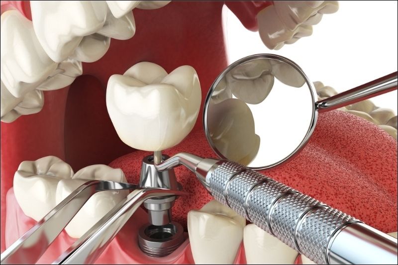 Trồng răng Implant là một phương pháp tối ưu khi mất răng