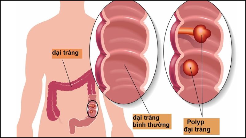 Polyp đại tràng hay còn được gọi là polyp hậu môn