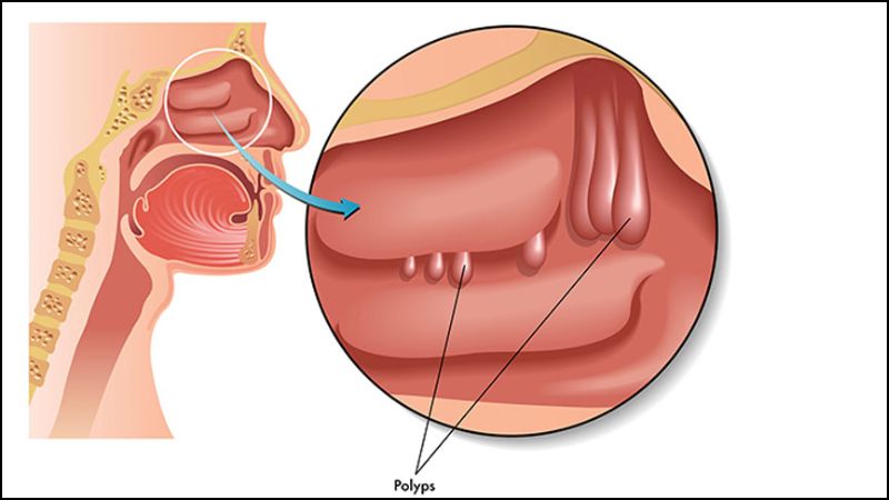 Polyp mũi là các khối u nhỏ lành tính phát triển trong niêm mạc mũi