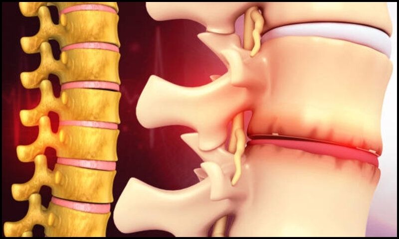 Bệnh thoái hóa cột sống thắt lưng xảy ra khi đĩa đệm cột sống bị mòn