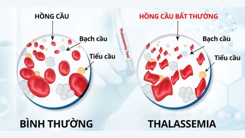 Rối loạn di truyền do Thalassemia gây ra khiến một lượng lớn tế bào hồng cầu bị phá hủy