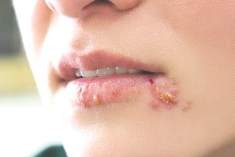 Nổi mụn rộp do Herpes có thể gây tê bì môi