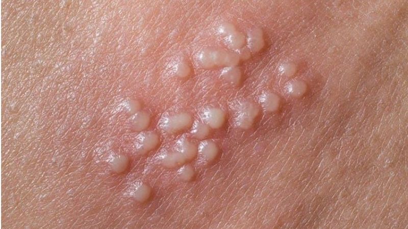 Herpes sinh dục có thể biểu hiện bằng một vài cụm mụn nước nhỏ