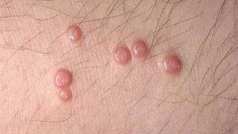 Mụn cóc sinh dục là bệnh da liễu khá phổ biến do vi-rút papilloma ở người (HPV) gây ra