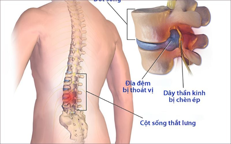 Bệnh về xương khớp là nguyên nhân phổ biến gây đau lưng mỏi gối tê tay