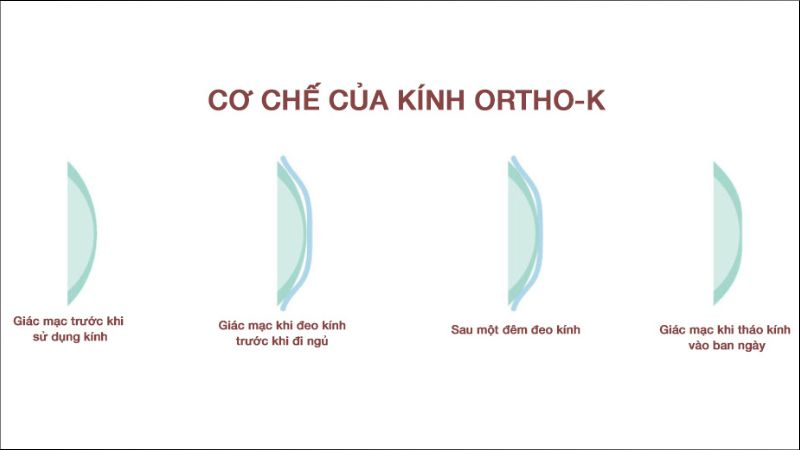 Ortho-K điều trị tạm thời chứng loạn thị