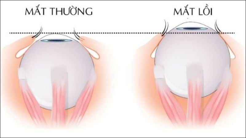 Mắt lồi là tình trạng một hoặc cả hai nhãn cầu nhô cao hơn so với vị trí tự nhiên