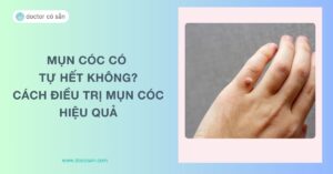 Mụn cóc có tự hết không? Cách điều trị mụn cóc hiệu quả nhất