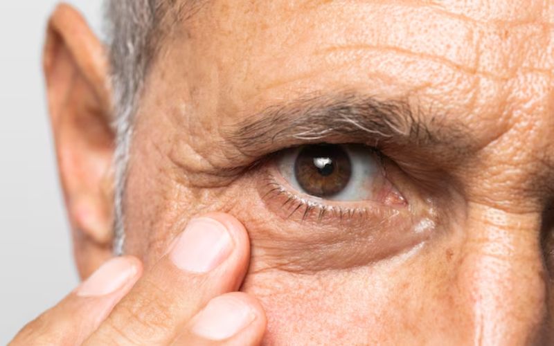 Glaucoma góc đóng xảy ra khi góc giữa mống mắt và giác mạc bị đóng hoặc hẹp lại