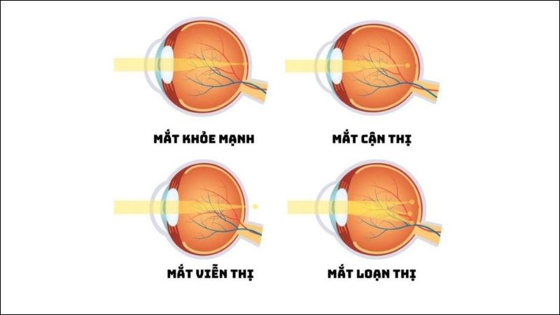 Tật khúc xạ khiến thị lực của mắt bị suy giảm