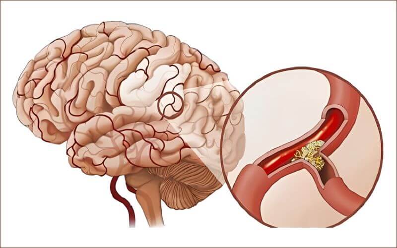 Với những người đã từng trải qua tai biến, mạch máu bị tắc nghẽn hoặc vỡ chính là nguyên nhân hàng đầu dẫn đến di chứng tê bì chân tay