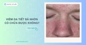 Viêm da tiết bã nhờn có chữa được không? Lưu ý khi điều trị bệnh