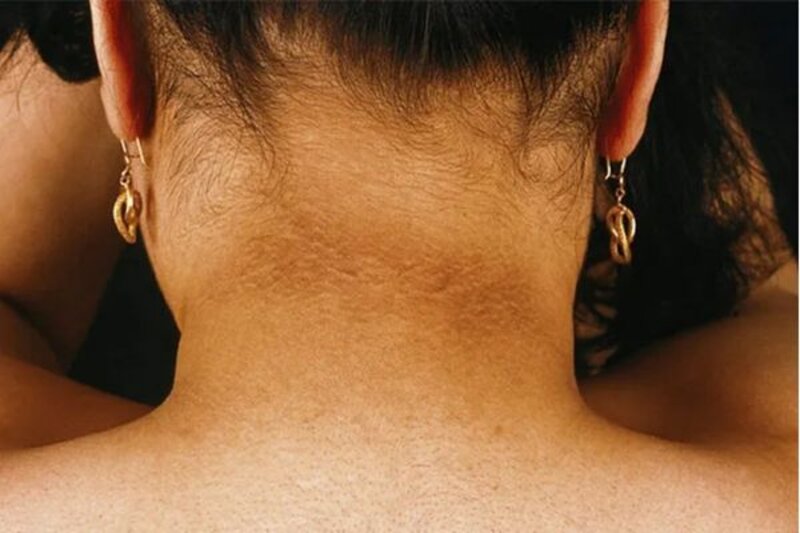 Bệnh gai đen hay acanthosis nigricans, là một biến chứng phổ biến ở những người mắc tiểu đường