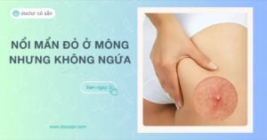 Nổi mẩn đỏ ở mông nhưng không ngứa là bệnh gì Cách điều trị hiệu quả