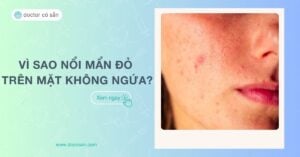 Vì sao nổi mẩn đỏ trên mặt không ngứa? Có nguy hiểm không? Cách xử lý