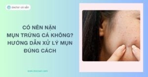 Có nên nặn mụn trứng cá không? Hướng dẫn xử lý mụn đúng cách