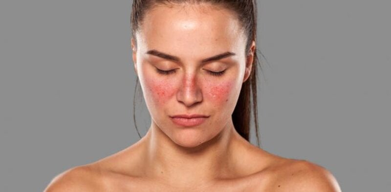 Ngoài mẩn đỏ trên mặt, lupus ban đỏ cũng có thể gây ra các nốt mẩn ở các vùng khác như cổ, cánh tay và bàn tay