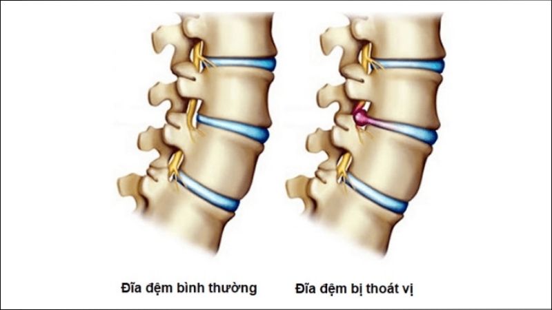 Thoát vị đĩa đệm gây chèn ép dây thần kinh cổ