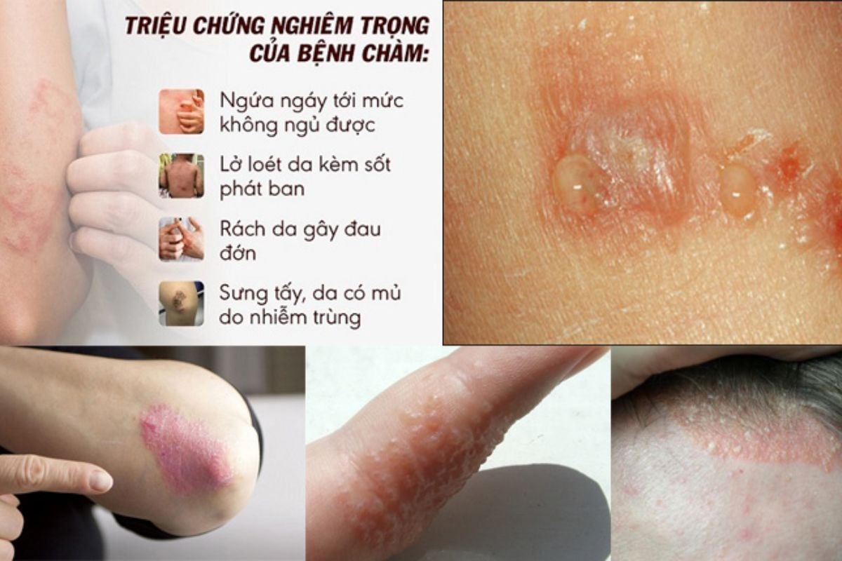 Eczema là một bệnh mãn tính trên da