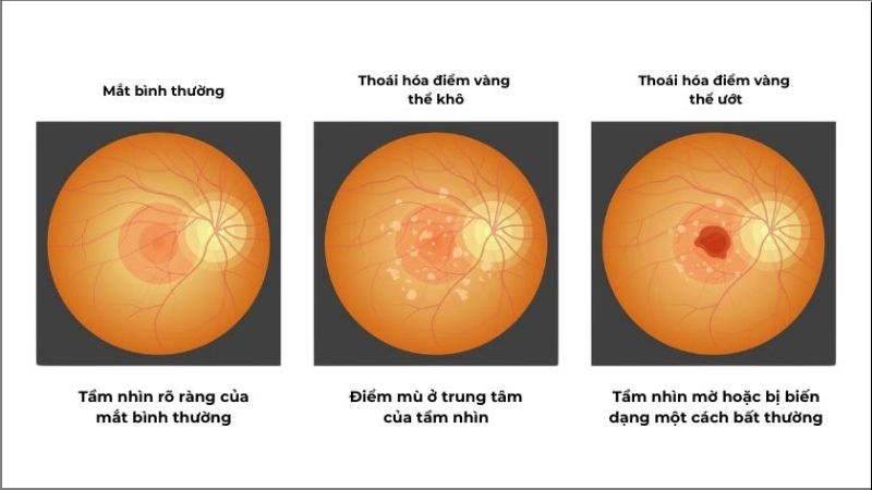 Bệnh thoái hóa điểm vàng là một tình trạng suy giảm thị lực ở vùng trung tâm võng mạc