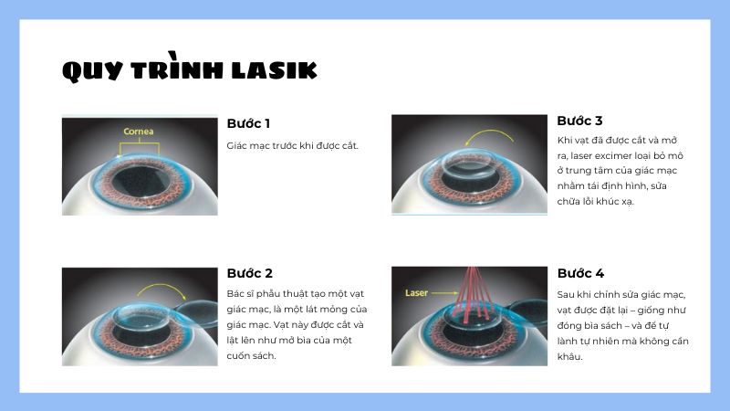 Phương pháp phẫu thuật khúc xạ mắt LASIK .