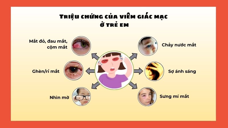 Đau mắt, cộm mắt, nhìn mờ, chảy nước mắt, mắt đỏ,... là các triệu chứng của viêm giác mạc ở trẻ em