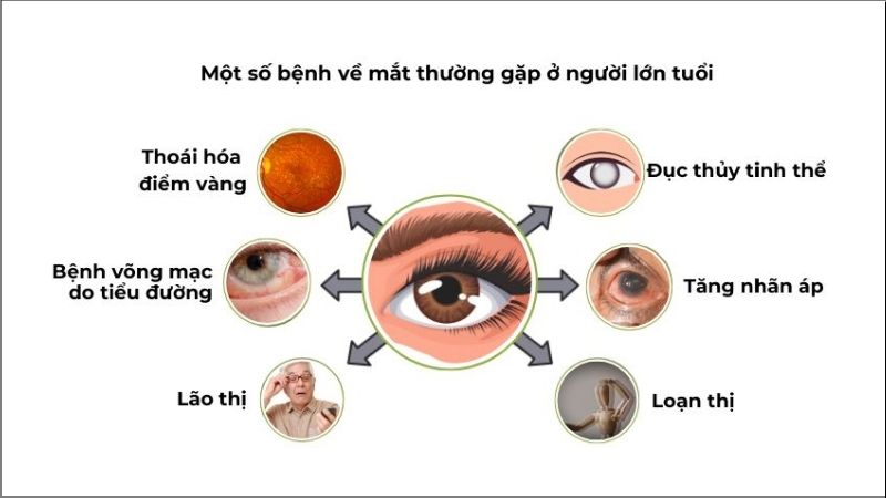 Các bệnh về mắt phổ biến liên quan đến tuổi tác