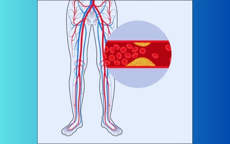 Bệnh động mạch ngoại biên đặc trưng bởi tình trạng đau chân kèm cảm giác tê