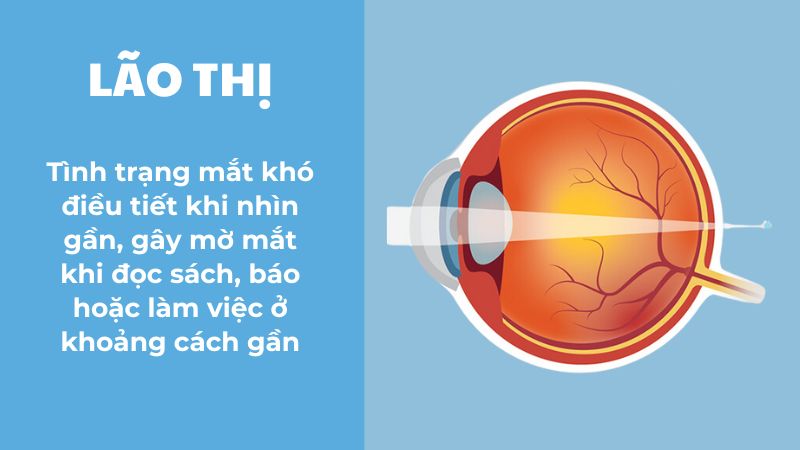 Lão thị là một trong các vấn đề thị lực thường gặp ở người lớn tuổi