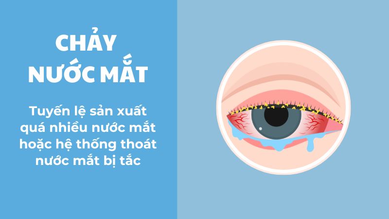 Chảy nước mắt xảy ra khi tuyến lệ sản xuất quá nhiều nước mắt.