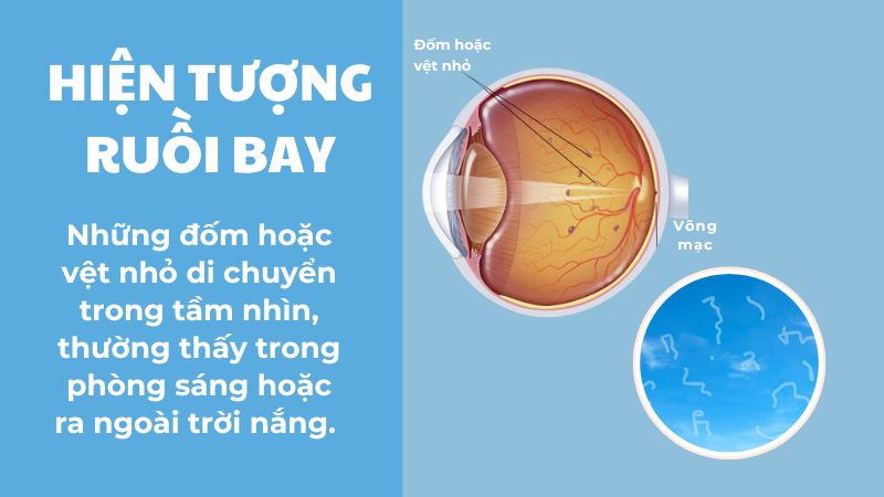 Hiện tượng ruồi bay là những đốm hoặc vệt nhỏ di chuyển trong tầm nhìn.