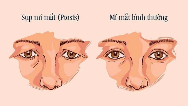 Sụp mí mắt ảnh hưởng lớn đến thị lực và thẩm mỹ