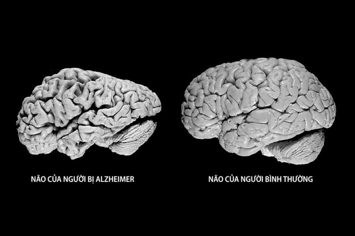 Bệnh Alzheimer gây tổn thương não