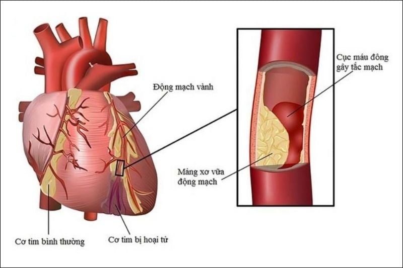 Xơ vữa mạch vành là nguyên nhân chính dẫn đến các cơn đau thắt ngực