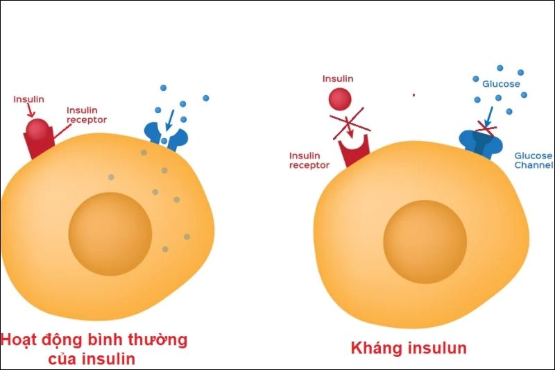 Kháng insulin xảy ra khi các tế bào không còn phản ứng tốt với insulin