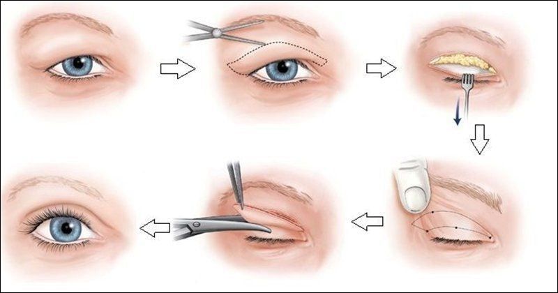 Quá trình phẫu thuật lấy mỡ mí mắt trên thường diễn ra nhanh chóng, chỉ mất khoảng 30 - 60 phút