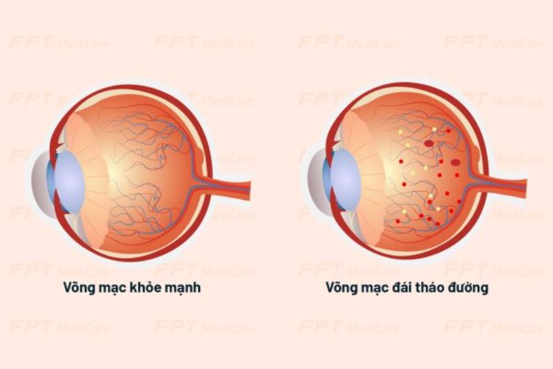 Bệnh võng mạc tiểu đường là một nguyên nhân gây mất dần thị lực