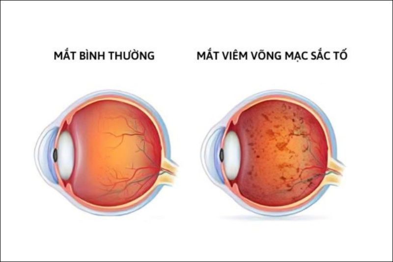 Viêm võng mạc sắc tố là một thoái hóa tiến triển chậm ở vùng võng mạc của mắt