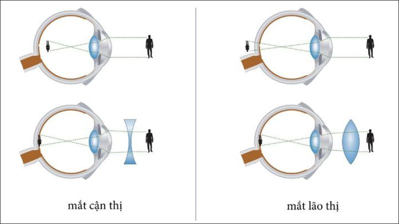 Cận thị và lão thị khác nhau như thế nào?