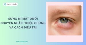 Sưng mí mắt dưới: Nguyên nhân, triệu chứng và cách điều trị