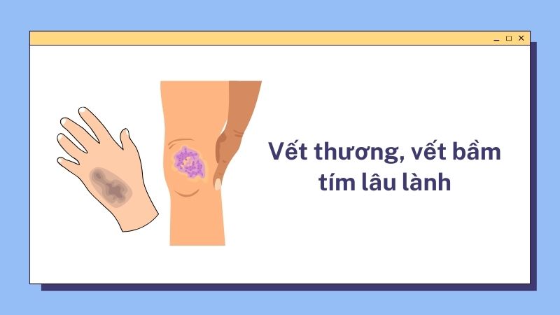 Một trong những dấu hiệu đái tháo đường thai kỳ là các vết thương, vết cắt, hoặc vết bầm tím lâu lành hơn bình thường.