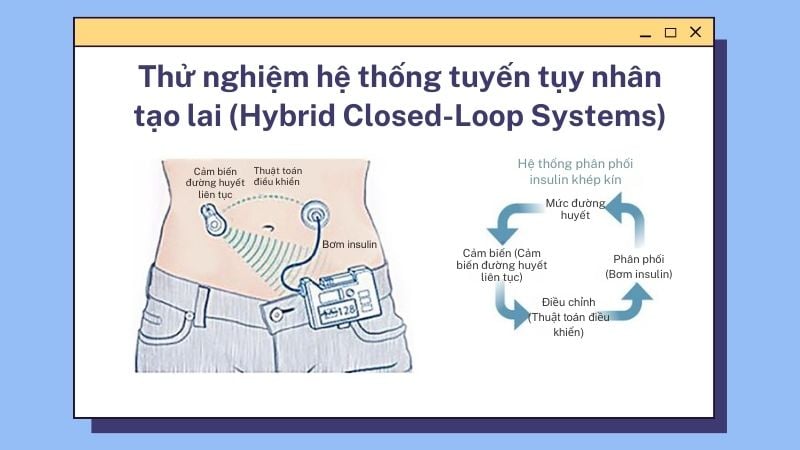 Hệ thống tuyến tụy nhân tạo hybrid cải thiện đáng kể khả năng quản lý đường huyết.